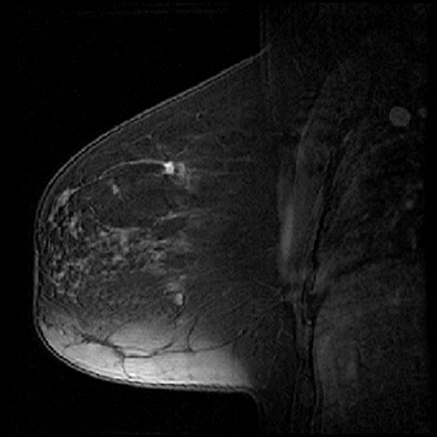 2013 01 15 15 37 57 22 Daye Low Risk Breast Mr Image 394