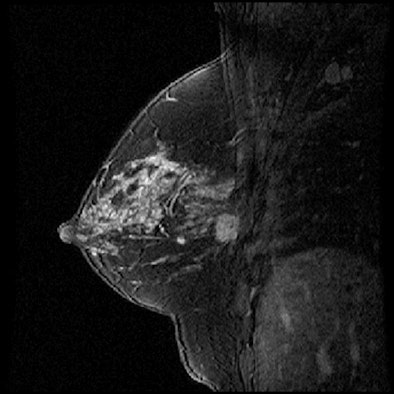 2013 01 15 15 37 59 380 Daye High Risk Breast Mr Image 394