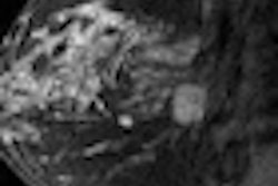 2013 01 15 15 37 59 383 Daye High Risk Breast Mr Image 70