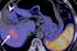 2013 01 17 15 02 40 360 Acetate Pet Ct Images Jnm Chung 450 20130117220613