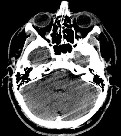 Poterior fossa CT scan