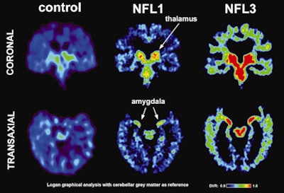 Normal versus athlete FDDNP-PET scans
