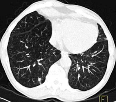 Spiculated nodule at CT