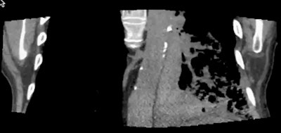 Patient with a left lower adenocarcinoma