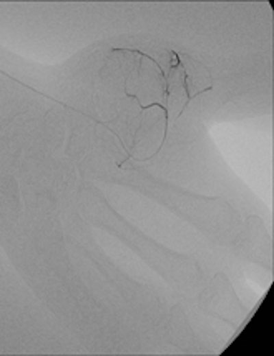 A 16-year-old female presented with a mass in her left hand
