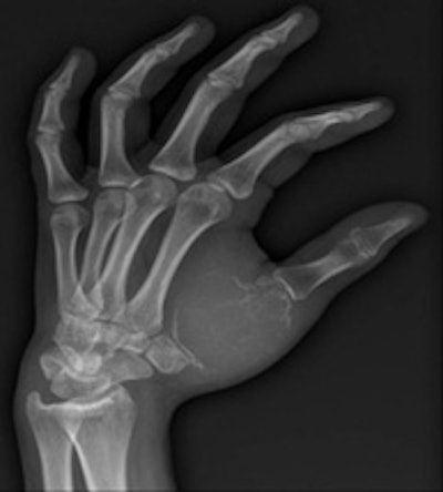 A 16-year-old female presented with a mass in her left hand