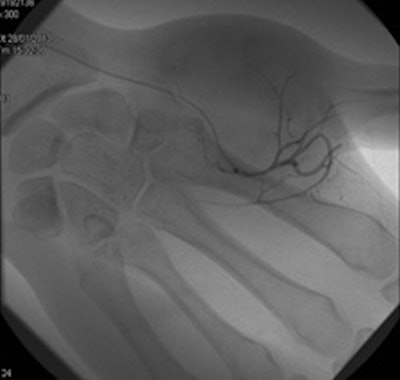 A 16-year-old female presented with a mass in her left hand