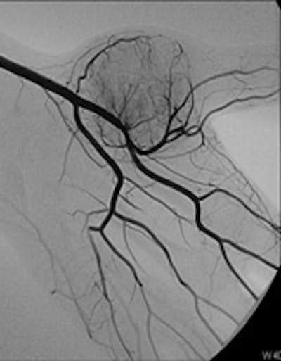 A 16-year-old female presented with a mass in her left hand