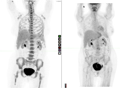 A fluoro-L-thymidine scan (left) and a fluorodeoxyglucose PET scan (right) of the same patient. Images courtesy of Dr. Peter Choyke.