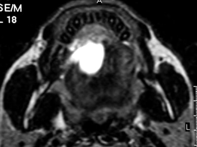 Axial T2-weighted MR image through the floor of the mouth shows a small squamous cell carcinoma (SCC) strategically located in the anterior floor of the mouth. The SCC is obstructing the draining ducts of the sublingual gland with an associated plunging ranula. Image courtesy of Dr. Alexandra Borges.