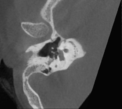 Conebeam CT double oblique reformation of the right temporal bone of a 12-year-old child with conductive hearing loss on the right side, showing a focus of otospongiosis anterior to the footplate. Images courtesy of Dr. Bert De Foer.