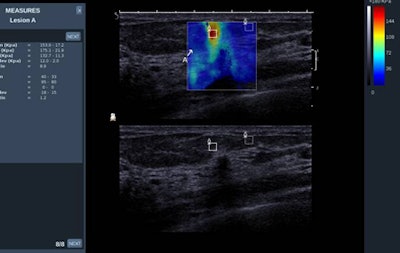 This clinical case is of a small infiltrating ductal carcinoma coded as red, i.e. elevated elasticity value. The resolution of the technique is 1 mm. Image courtesy of Dr. Alexandra Athanasiou.