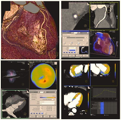 Today, contrast-enhanced cardiac CT is mainly used to display cardiac and coronary morphology in motionless images. Results can be displayed through volume-rendering techniques (top left) or dedicated software can be used for a detailed analysis of the coronary arteries and potential coronary artery stenosis -- e.g., using curved multiplanar reformats (top right). However, cardiac CT can also analyze cardiac function (global functional parameters and also regional wall motion, displayed in color maps, bottom left). Recent developments and research are focusing on the assessment of myocardial perfusion -- e.g., using dynamic, time-resolved acquisition modes. This way, blood flow through the myocardium can be displayed in color maps or in time-density curves, potentially allowing assessment of the hemodynamic significance of a given coronary artery stenosis (bottom right).