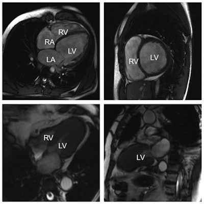 Top row: Example of a dilated cardiomyopathy (DCM). Cine-MR images in four-chamber view (left) and short-axis view (right) at end-diastole show significant dilatation of the left ventricular cavity. Ejection fraction was less than 35% in this patient. (RA = right atrium; LA = left atrium; RV = right ventricle; LV = left ventricle). Bottom row: Example of an asymmetrical, apical hypertrophic cardiomyopathy (HCM). Cine-MR images in a four-chamber (left) and two-chamber view (right) in systole show a markedly thickened left ventricular myocardium predominantly of the apex, as compared with the basal segments. All images courtesy of Dr. Konstantin Nikolaou.