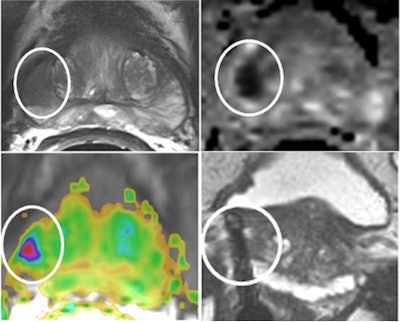 A 69-year-old patient with a low-grade (Gleason 3+3) prostate cancer (1/10 cores positive, < 5%) confirmed by transrectal ultrasound biopsy. Therefore, the patient was a candidate for active surveillance. Top left: T2-weighted MRI shows low-signal lesion (circle) in right peripheral zone. Top right: ADC map shows restriction is this area (ADC value: 650), and bright area on high b value (1400) diffusion-weighted image. Bottom left: Dynamic contrast-enhanced MRI shows focal unilateral area with curve type 3. Prostate imaging reporting and data system (PI-RADS) classification for significant cancer: 5-5-5, final score 5. This fits an aggressive tumor. Bottom right: MR-guided biopsy shows lesion (circle); needle = white line, showed 2/2 cores each 80% Gleason 4+3 prostate cancer. Due to this MRI examination, this patient's prospects have improved, and he will now have a prostatectomy. Images courtesy of Dr. Jelle Barentsz, PhD.