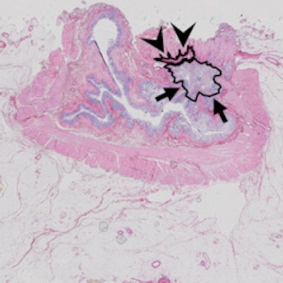Same case as above. Histopathology confirmed the areas of residual tumor (arrows) and fibrosis (arrowheads).