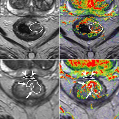 Perfusion MRI of a rectal tumor compared with histology. Top left: T2-weighted MR image of a patient with rectal tumor (encircled) before chemoradiotherapy. Top right: Corresponding perfusion MR image (K-trans map). There is a heterogeneity in tumor angiogenic activity with areas of higher (red) and lower K-trans values. Bottom left: T2-weighted MR image of the same patient after irradiation of the tumor. Bottom right: Corresponding perfusion MR image (K-trans map). Residual tumor (white arrows) is visualized, showing persistent heterogeneous angiogenic activity with areas of high (red) and low K-trans values (arrowheads pointing at fibrosis in the anterior rectal wall). All images courtesy of Dr. Regina Beets-Tan, PhD.