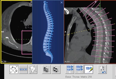 FAST Spine, a component of FAST CARE, can deliver an automatic segmentation of the spinal canal and automatic labeling of the vertebrae. Image courtesy of the University Hospital of Zurich.
