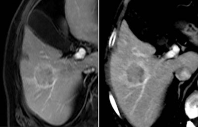 3-tesla MRI examination of the liver (left) compared with a CT image using the Iterative Model Reconstruction (IMR) technique. The lesion detected on CT was confirmed by MRI. Images courtesy of Philips Healthcare.