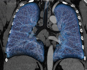 In this case of lymphoma, the VRT image shows multiple enlarged lymph nodes in the mediastinum and anatomical details in the lungs. Image courtesy of Clinique Sainte Marie, Paris.