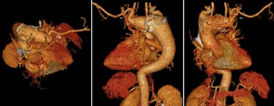 A 57-year-old man with vascular ring, 'double aortic arch,' huge Kommerell's diverticulum, and aneurysm of the descending aorta. Dysphagia and increasing diameter of the diverticulum can be seen. Images courtesy of Dr. Michael Hübler.