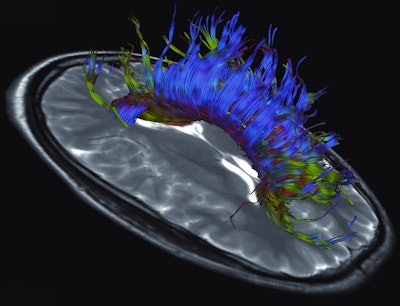 Diffusion-tensor imaging can help to improve visualization of white-matter fiber tracts. Image courtesy of Philips.