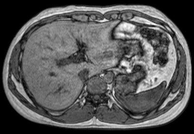 Dynamic liver imaging using the mDixon technique. Complete coverage of the liver is possible in a breath-hold of only 15 seconds. Image courtesy of Philips.