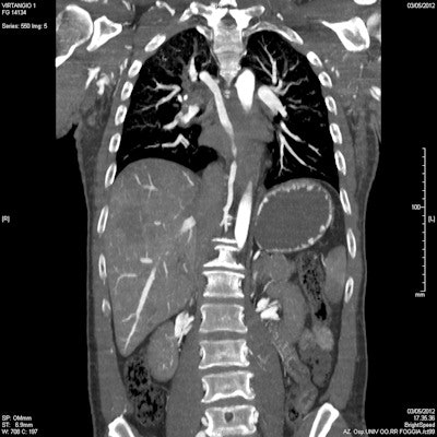Postmortem whole-body CT angiography. Pulmonary embolism: Coronal multiplanar reconstruction (MPR) showing the filling defect in the right descending branch of the pulmonary artery.