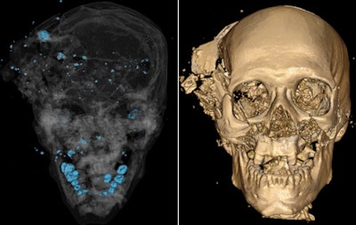 Left: Bone and metal maximum intensity projection reconstruction. Right: Volume-rendered 3D CT reconstruction. Homicidal death: Characteristic bony and metallic fragments on the exit side of the skull, where the bullet caused a large loss of brain, leading to shattering of the skull. All images courtesy of Dr. Giuseppe Guglielmi.
