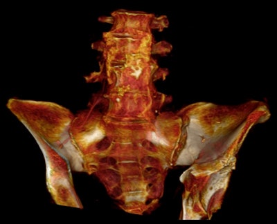 2013 03 09 13 17 59 323 6 D Iliac 400