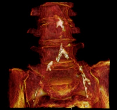 2013 03 09 13 18 02 541 6 B Iliac 400