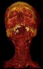 CT reconstruction showing carotid artery disease
