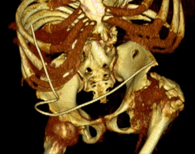 Left: A 33-year-old male with spina bifida. Reconstructed coronal maximum intensity projection CT image shows bilateral staghorn calculi and horse-shoe kidney. Right: A 37-year-old male with spina bifida. 3D reconstruction demonstrates the logistical difficulties with imaging, treatment, and management due to gross bony deformities. Images courtesy of Dr. Sanjay Agarwal.
