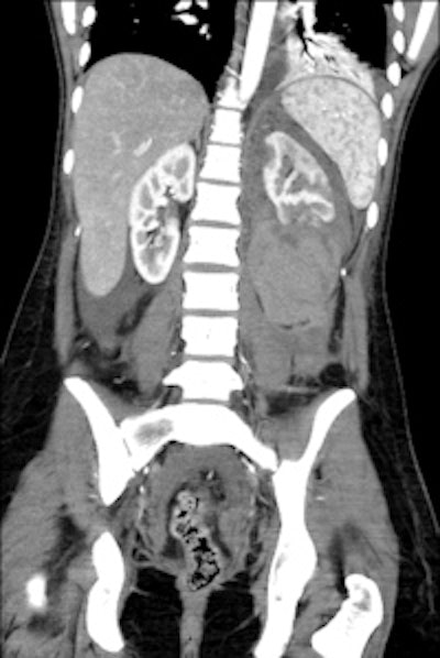 An 18-year-old female with 'after-party amnesia' presented with severe stomach pain and bruises to the head. An investigation showed vaginal bleeding was from the bladder. Full-scale emergency room investigation showed severe left kidney fracture and contusion, but intact vessels and ureter. Three-month follow-up renography shows 28% kidney function on left side as the only sequelae. Image courtesy of Dr. Vibeke Logager.