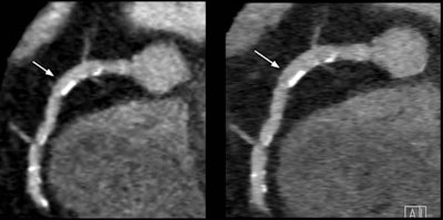 Use of the IC detector in coronary CT angiography yielded higher image quality in patients, both with (right) and without (left) the use of iterative reconstruction.