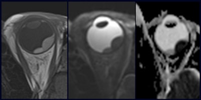 Ocular melanoma DWI-MRI