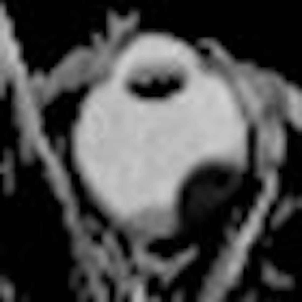 Dwi Mri Assists Proton Beam Therapy For Ocular Melanoma Auntminnie