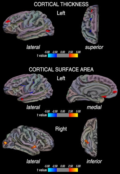 Image shows regional differences in cortical thickness and cortical surface area in patients with migraine compared with healthy control subjects. Regions of increased cortical thickness or surface area are shown in red and regions of decreased cortical thickness or surface area are shown in blue. Image courtesy of Radiology.
