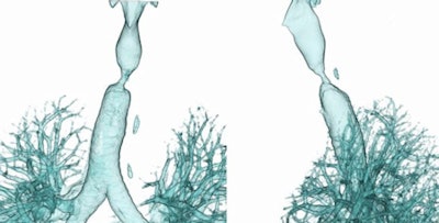 Central airway stenosis preoperation