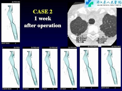 Central airway stenosis at one week