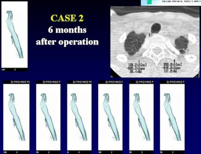 Central airway stenosis at six months
