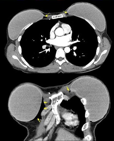 Axial and coronal CT images demonstrate gas collecting in the medial retropectoral space in this patient five years after bilateral mastectomies with silicone implant reconstruction. Image courtesy of Dr. John M. Lewin.
