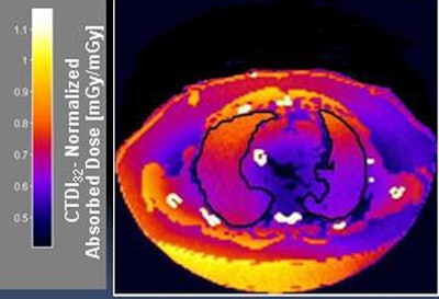 Individualized dose maps account for patient size and individual organ dose. All images courtesy of Carla Thompson and Sandra Halliburton, PhD.