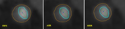 Cross section of a noncalcified plaque reconstructed with the three different algorithms (left to right: FBP, ASIR, MBIR). No significant differences can be seen between the three algorithms in terms of correct delineation of the plaque borders. All images courtesy of Dr. Stefan Puchner.