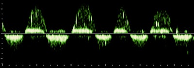 There are high-velocity spicules in the tracing. We have tended to think of these as microturbulence events, signaling the presence of surfactants in ejected lung fluid. This is unusual at the current gestational age in a male fetus, except when there has been repeated stress promoting lung maturation.