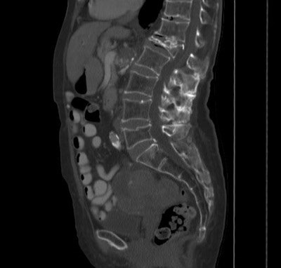 Above and below: In a patient with an L1 compression fracture, low attenuation in the L2 vertebra (27 HU) was used to diagnose osteoporosis at CT. All images courtesy of Dr. Perry Pickhardt.