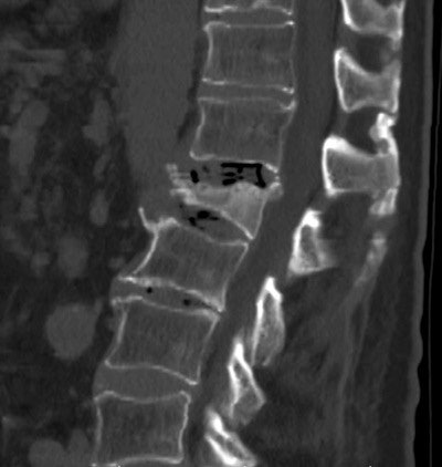 DEXA results were normal in a patient with an L1 compression fracture and osteoporosis at CT.