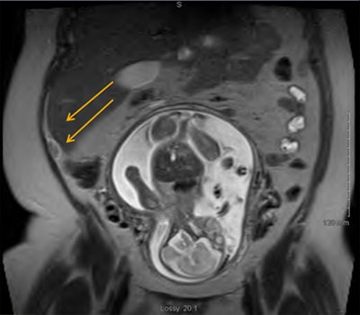 MRI of pregnant woman suspected with appendicitis