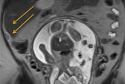 2013 04 19 12 39 10 642 2013 04 22 Mri Appendicitis 200