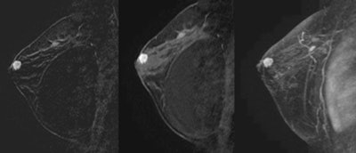 MRI of a 38-year-old woman with saline implants for two years and a family history of breast cancer. The patient had a palpable mass with a negative mammogram; guided biopsy yielded invasive ductal carcinoma. All images courtesy of Dr. Victoria Mango.